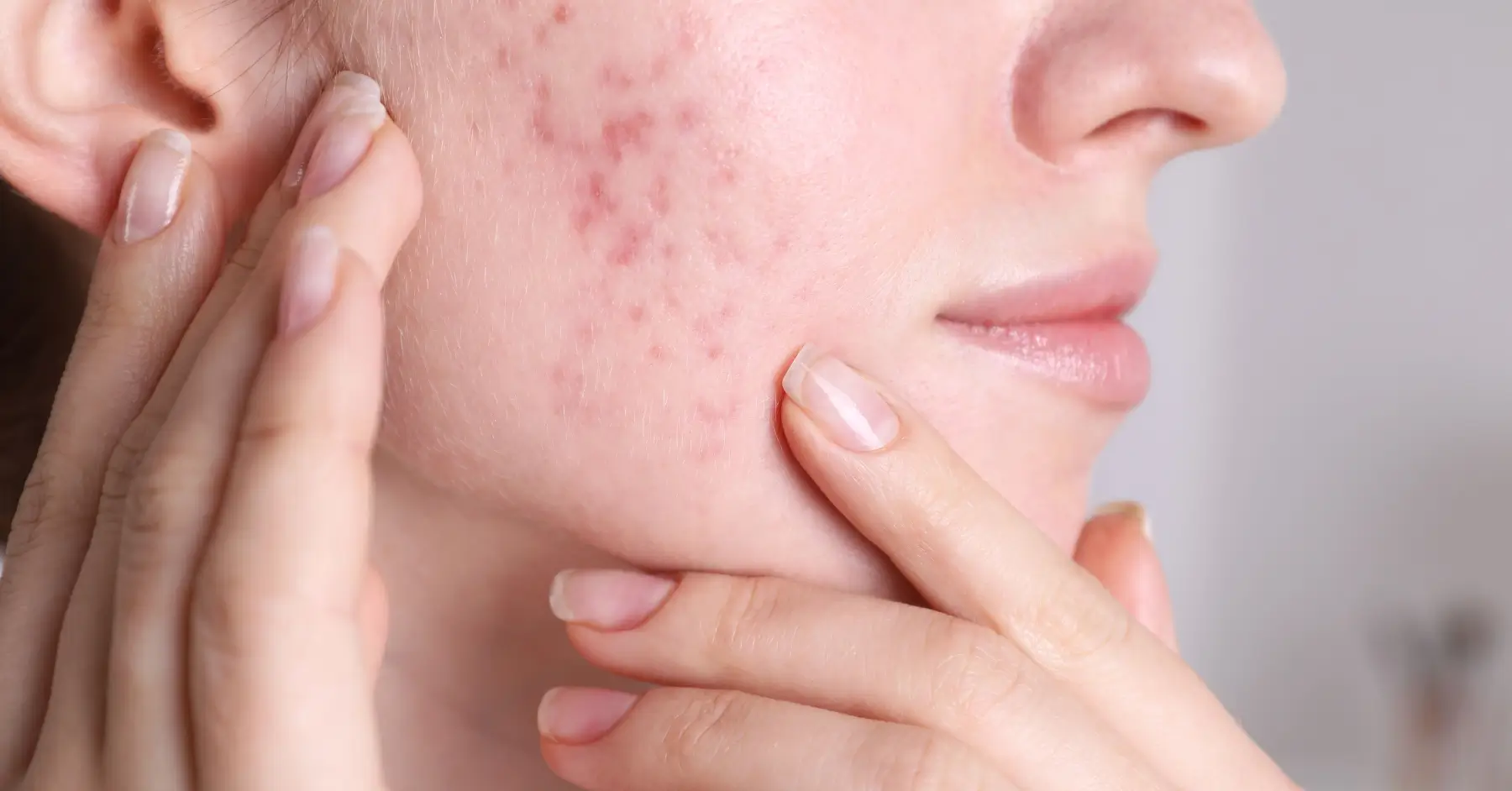 can black mold cause acne